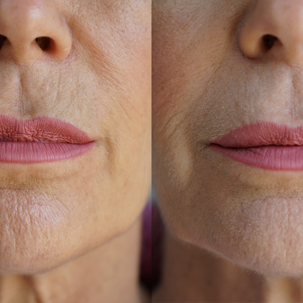 Ageless Lip & Line Filler